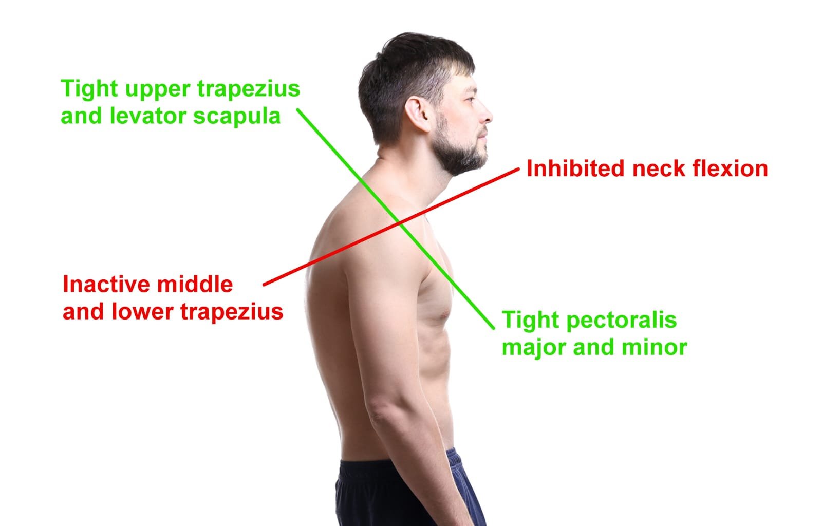 Upper cross syndrome posture diagram with tight and inactive muscle labels